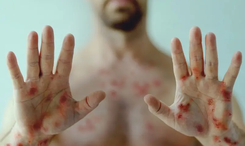 Confira orientações da Secretaria da Saúde a profissionais e população em geral sobre a Mpox