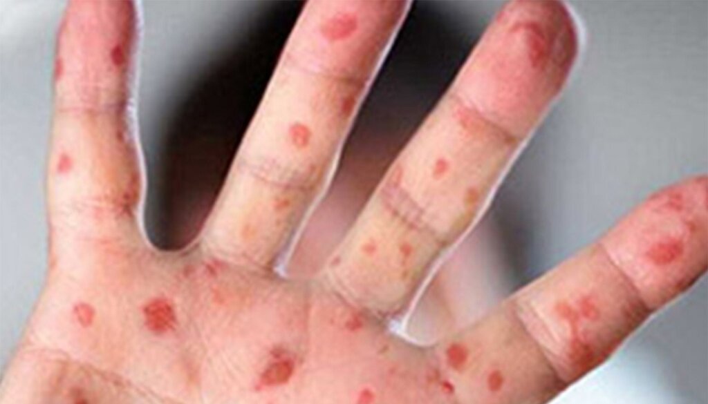 Volta às aulas após recesso de inverno acende alerta para risco de reintrodução do sarampo no Estado