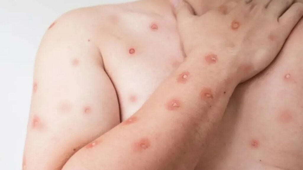 Porto Alegre confirma primeiro caso de mpox em 2026; paciente contraiu vírus fora do Estado
